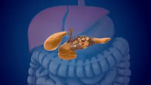 AI Spots Pancreatic Cancer Years Before It Shows Up, Study Finds