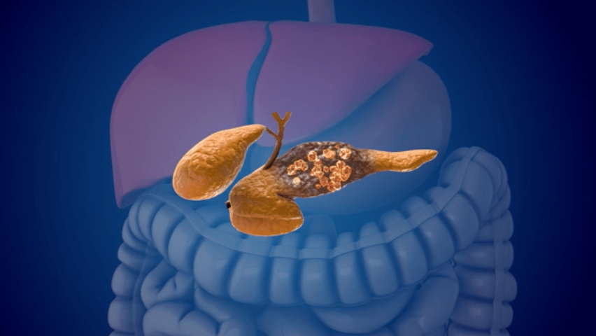 AI Spots Pancreatic Cancer Years Before It Shows Up, Study Finds